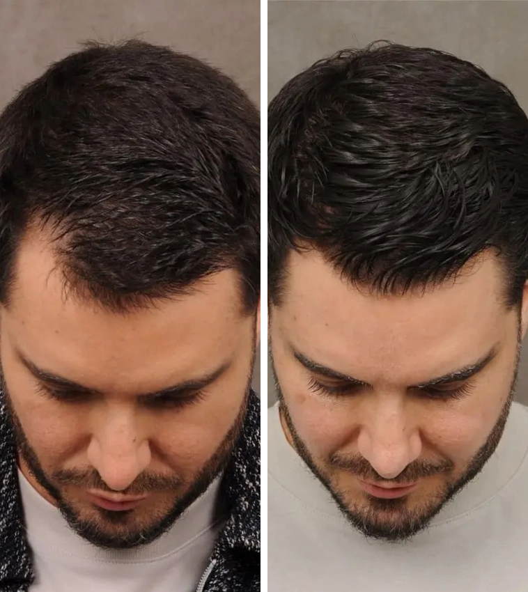 Best hair loss treatment UK