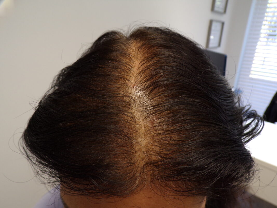 At 4 months, front