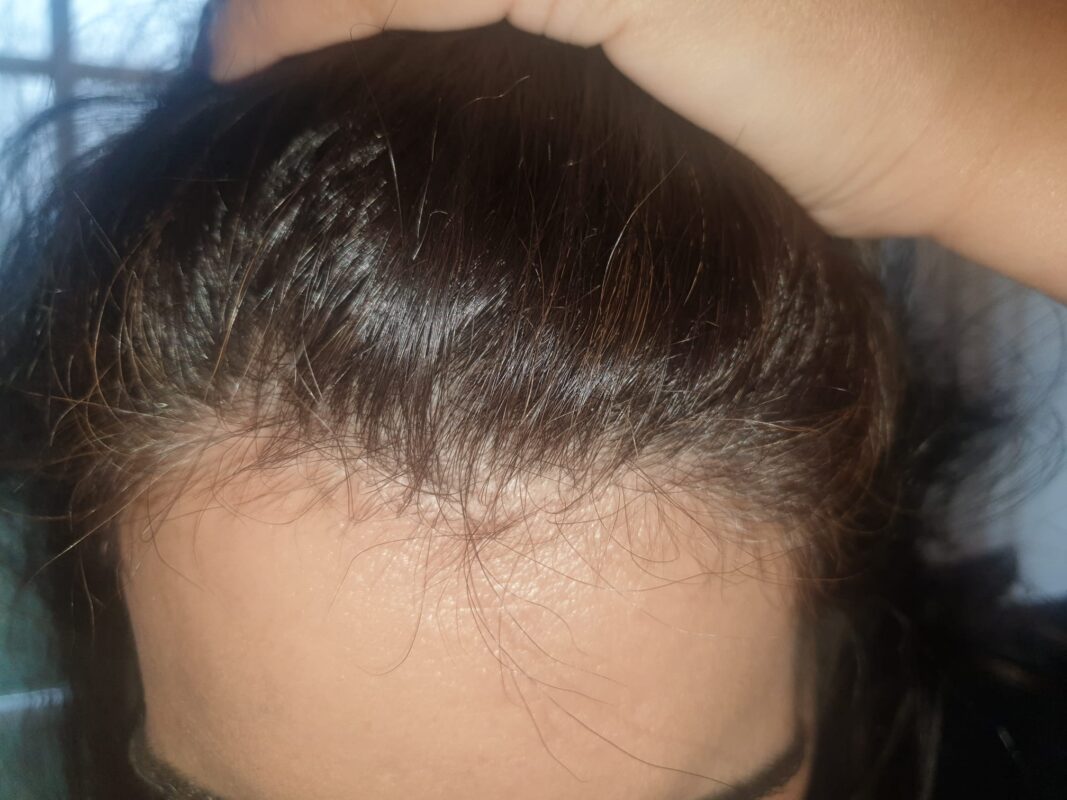 At 3 months