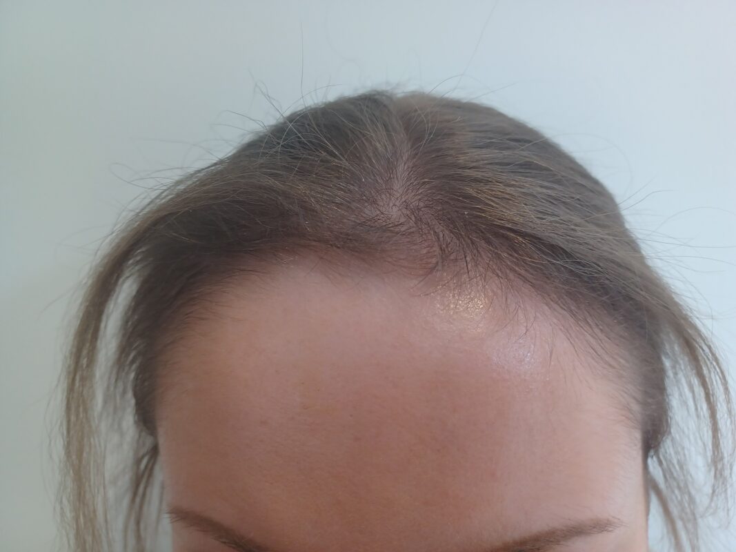 3 months into treatment