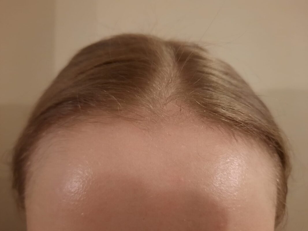 Frontal photo before treatment