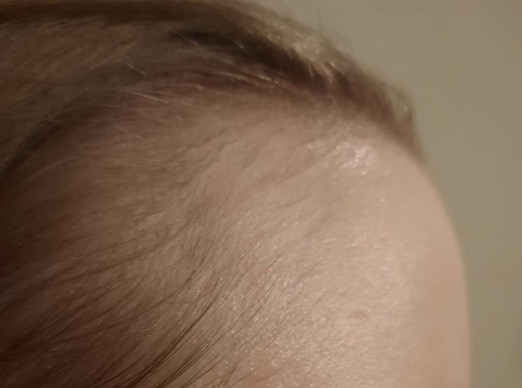 Right temporal photo before treatment