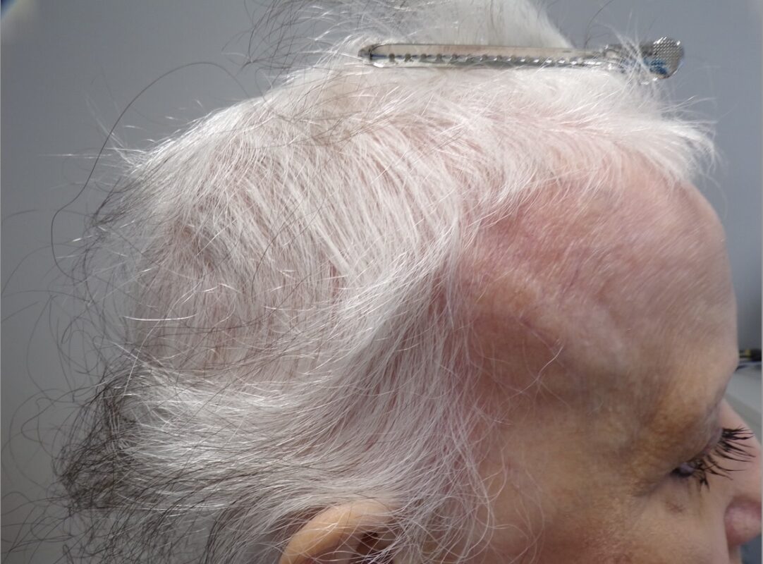 Right temporal photo before treatment