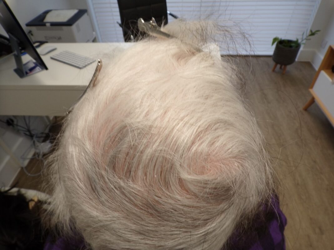 The crown before starting treatment