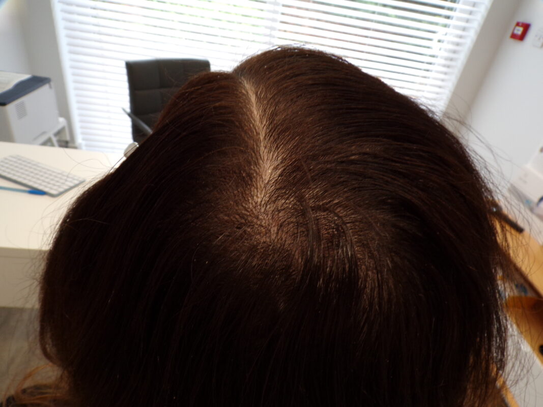 3 months into treatment