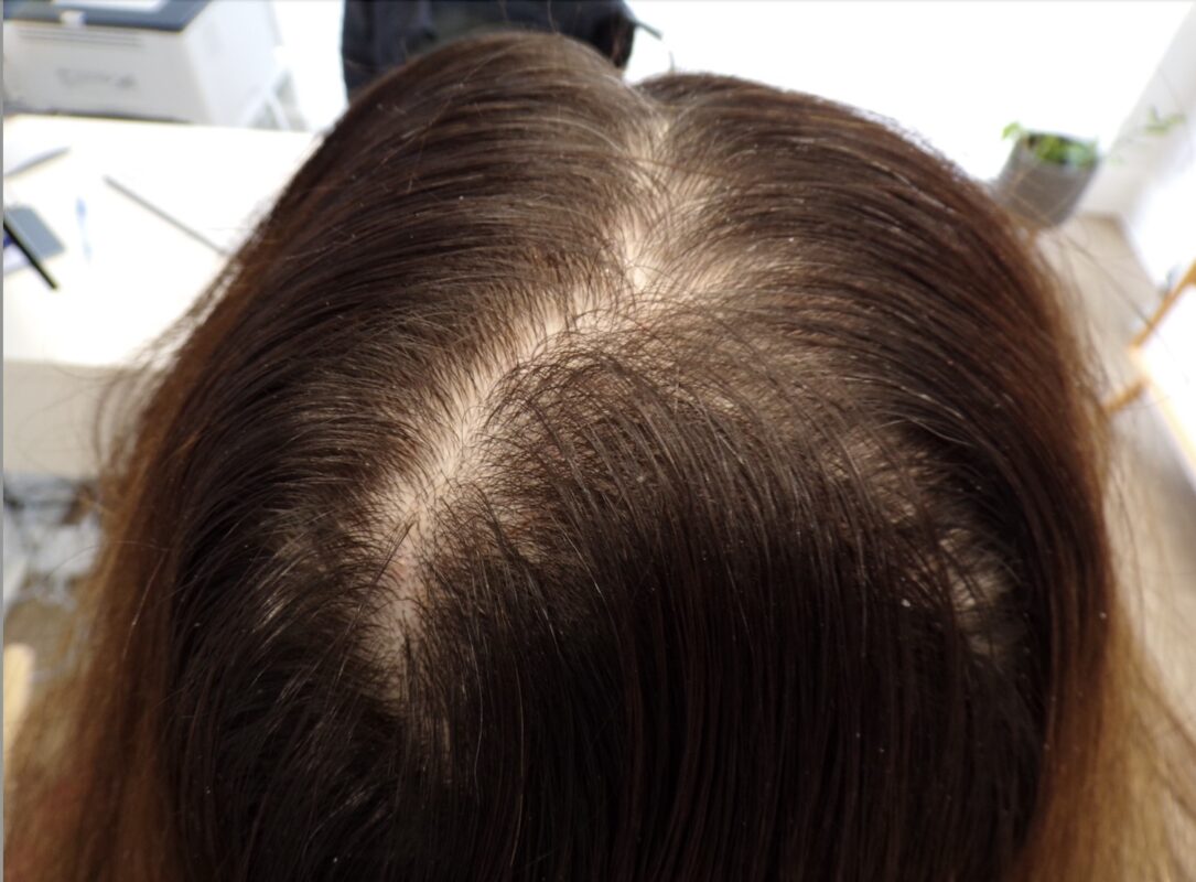 The crown area before starting treatment