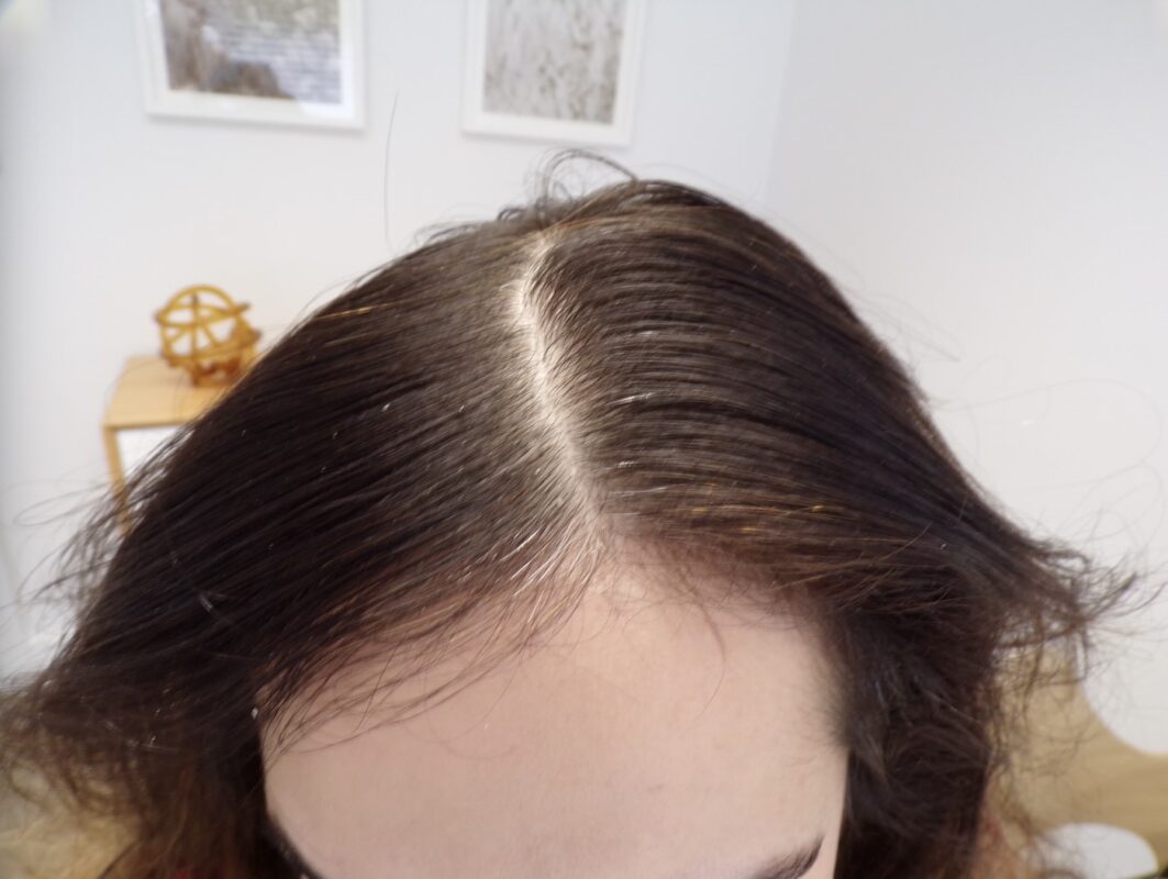 Frontal area before treatment