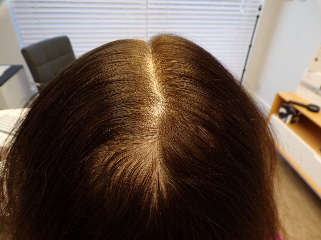 Crown before treatment