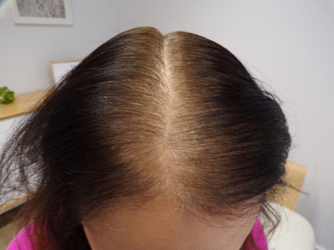 Mid-scalp before starting treatment