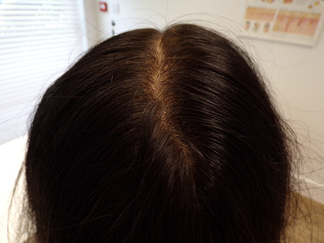 Crown 7 months into treatment