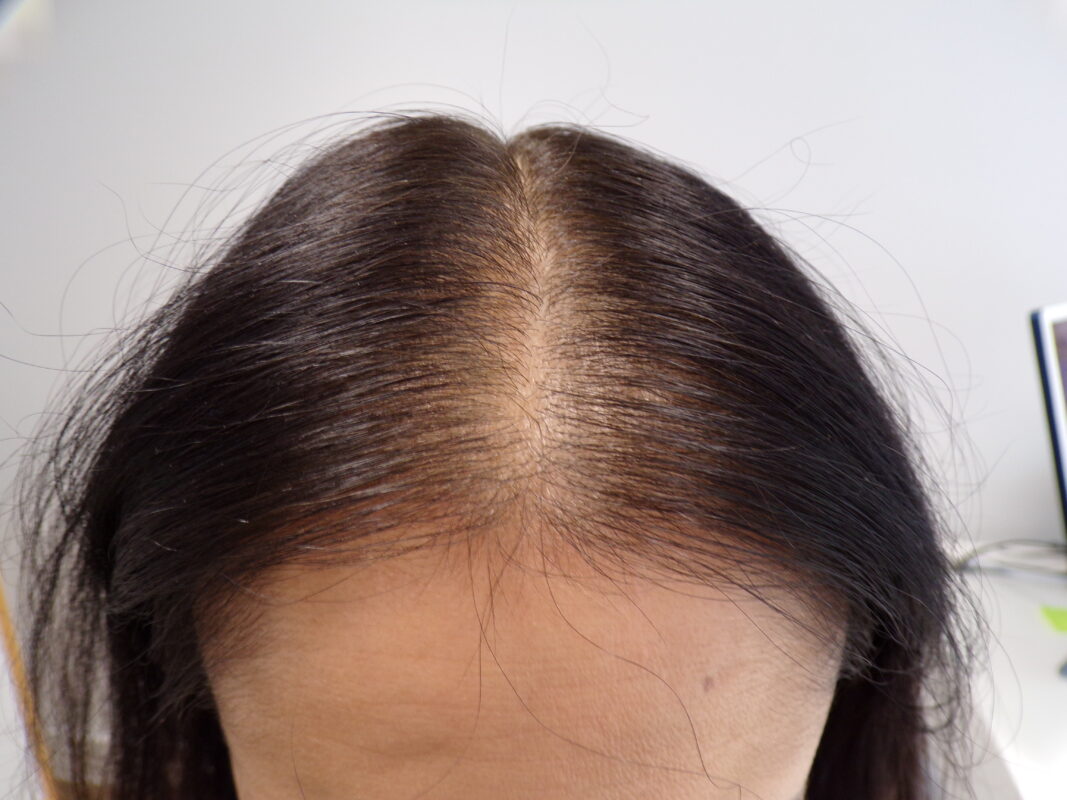 Mid-scalp 7 months into treatment