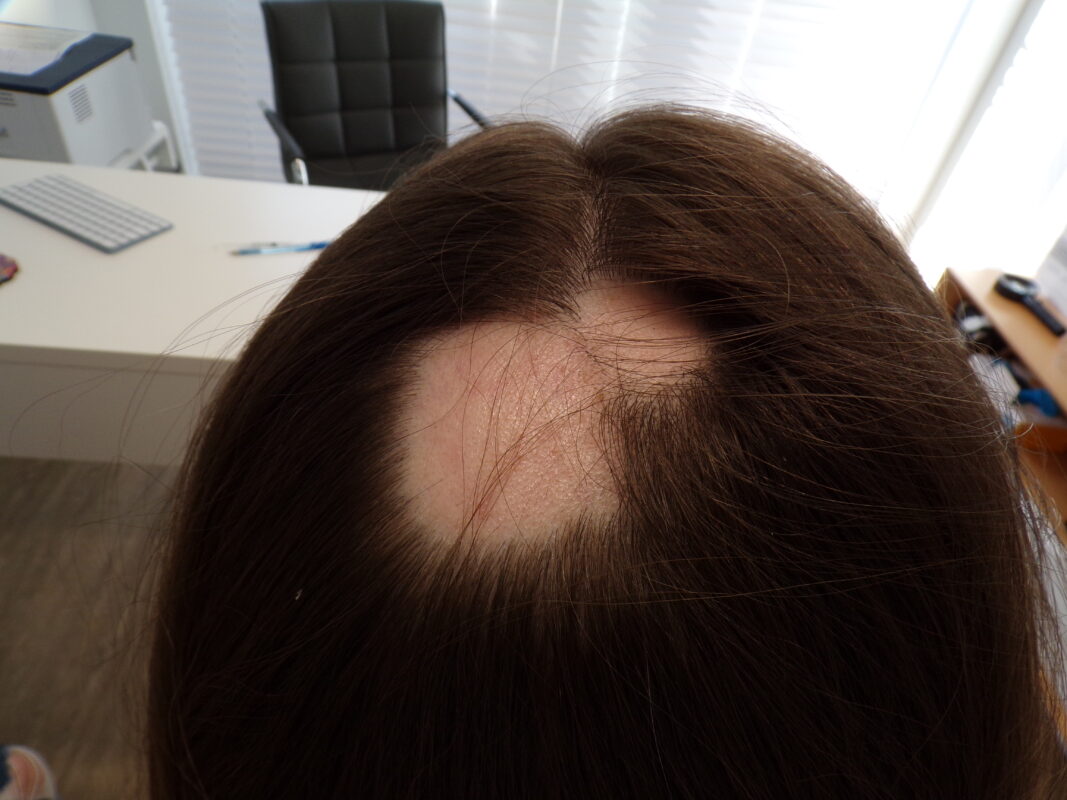 Alopecia Areata patch before treatment