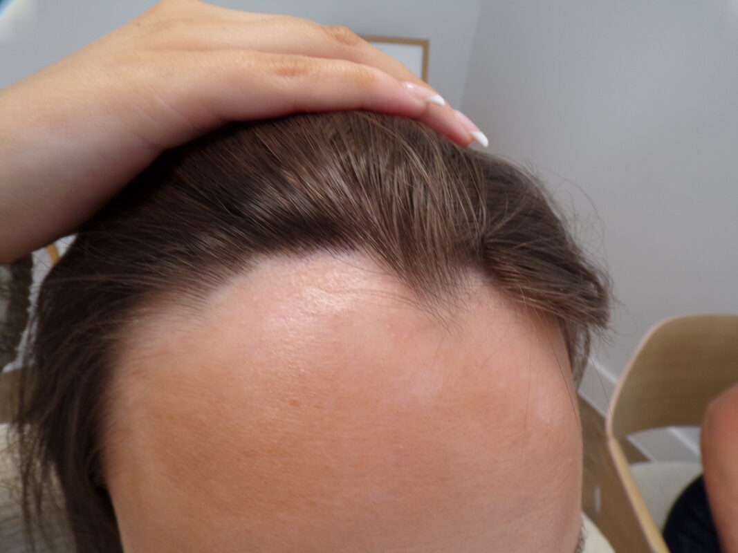 Frontal hairline Alopecia Areata patch before treatment