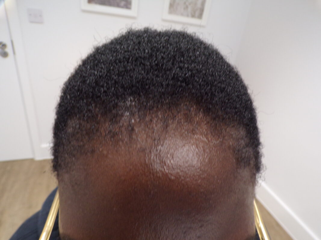 Frontal hair line - Traction alopecia before treatment