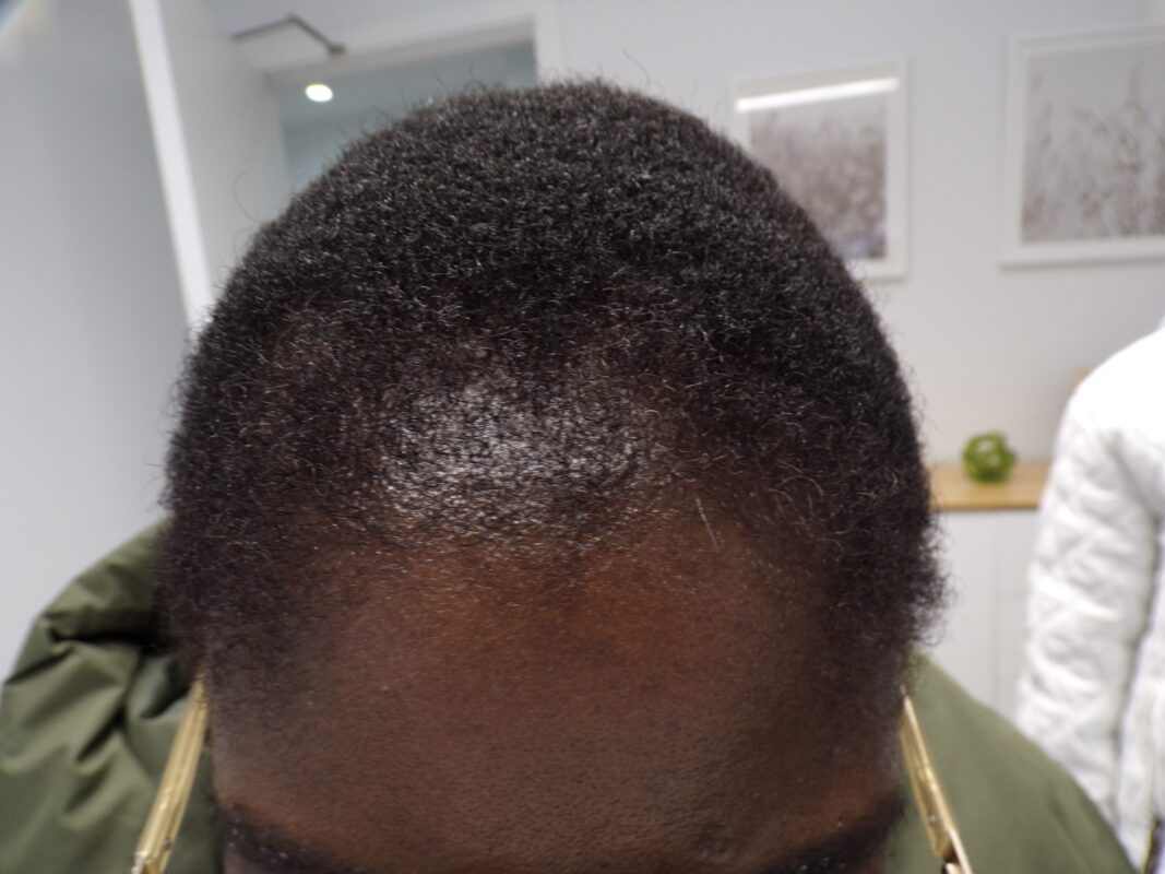 4 months into treatment