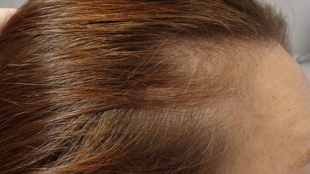 Temporal region before treatment