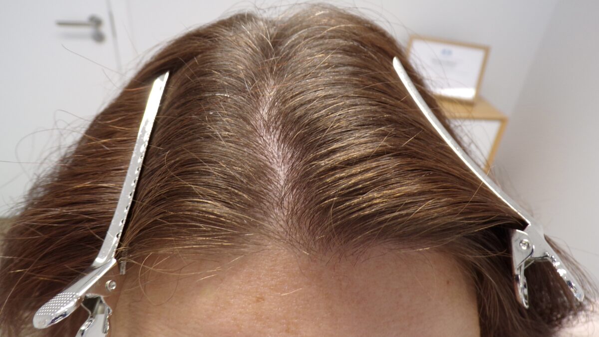 Before treatment
