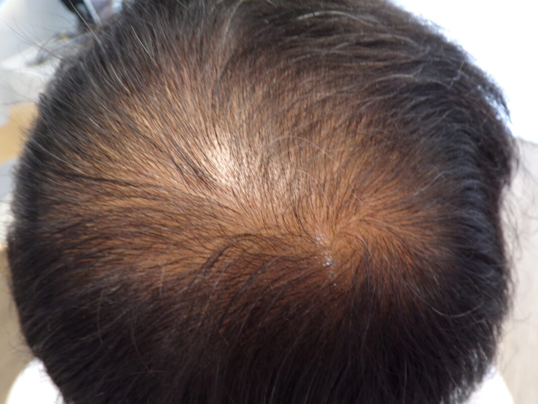 Crown before treatment
