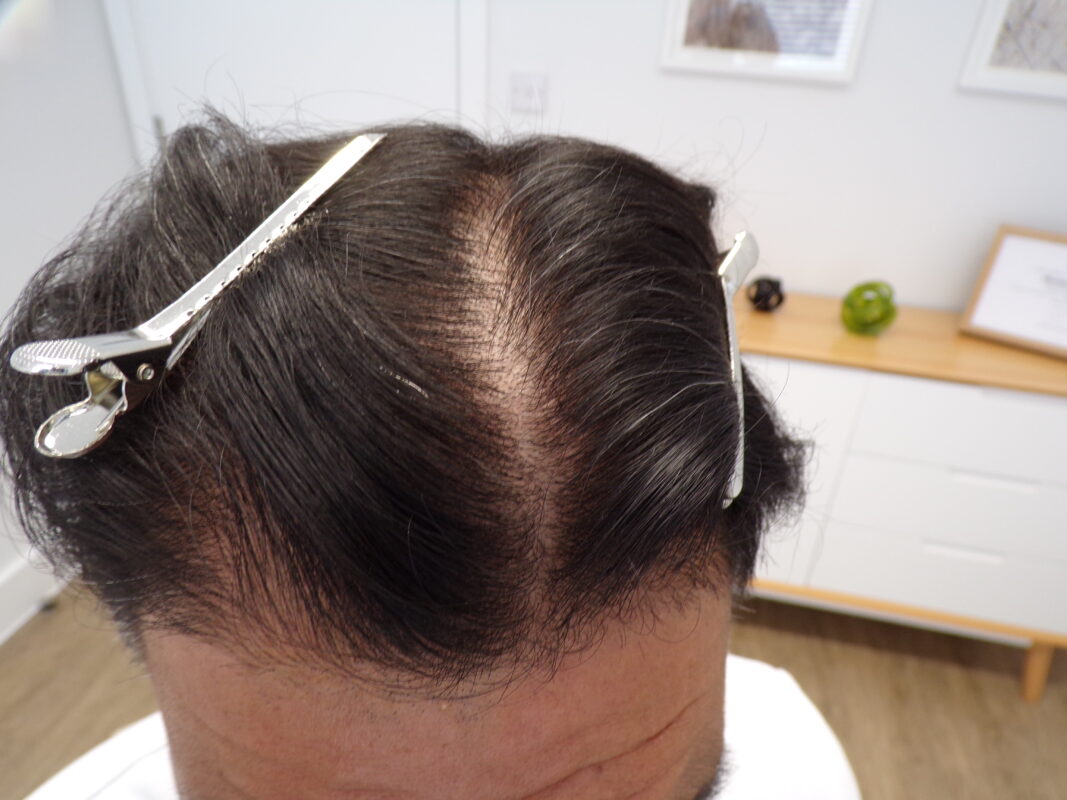 Before treatment