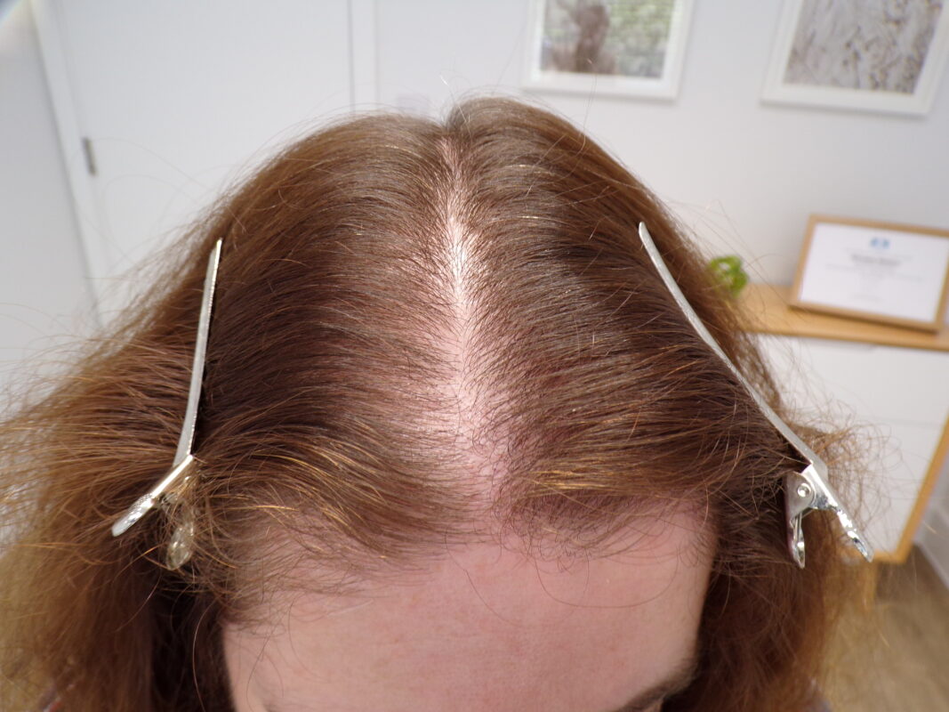 Mid-scalp area before treatment