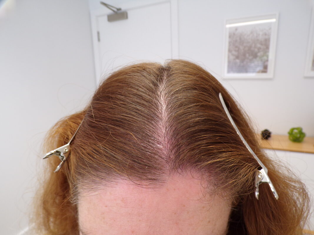 Mid-scalp area after 3 months of treatment
