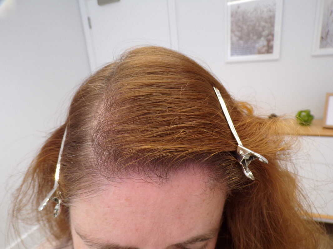 Hair after 3 months of treatment