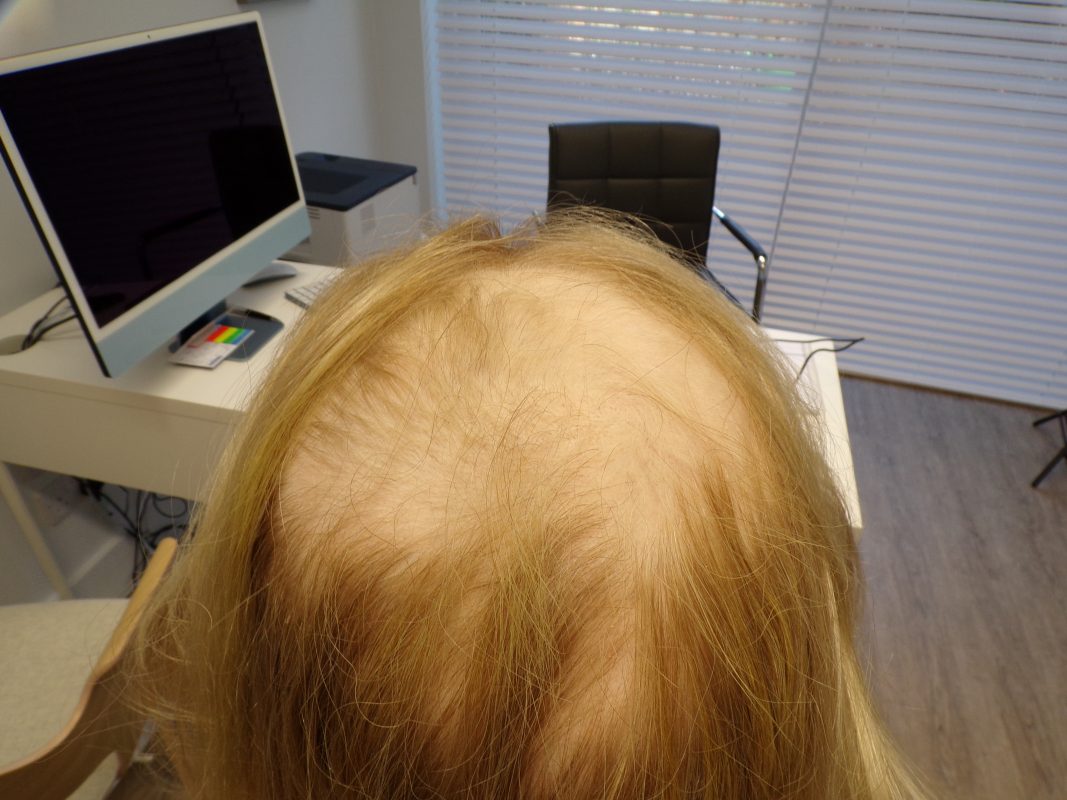 At 2 month of treatment