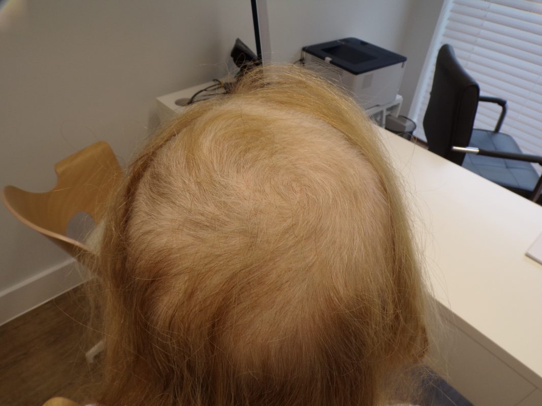 At 3 months of treatment