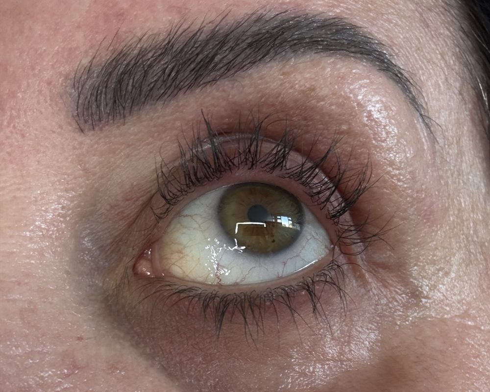 Left eye after 3 months treatment