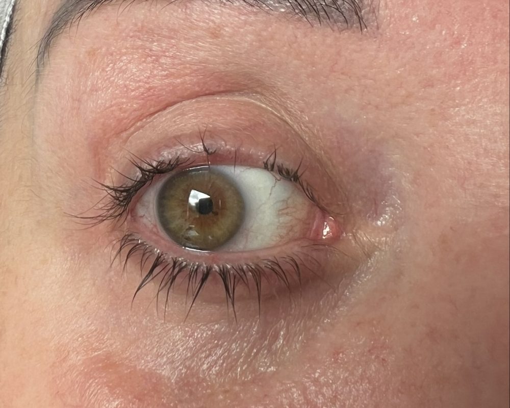 Right eye before treatment