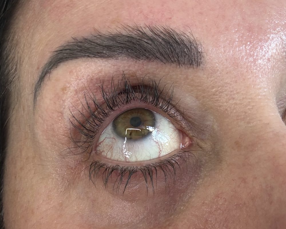 Right eye after 3 months treatment