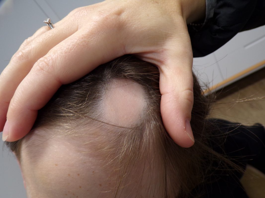 Alopecia areata patch before treatment