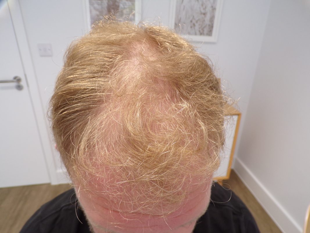 Frontal and Mid-scalp area before treatment