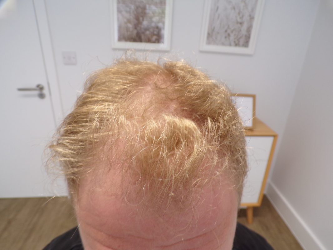 Frontal region before treatment