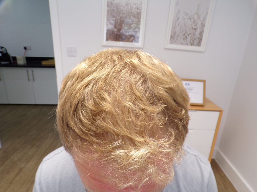 Frontal and Mid-scalp area after 4 months treatment
