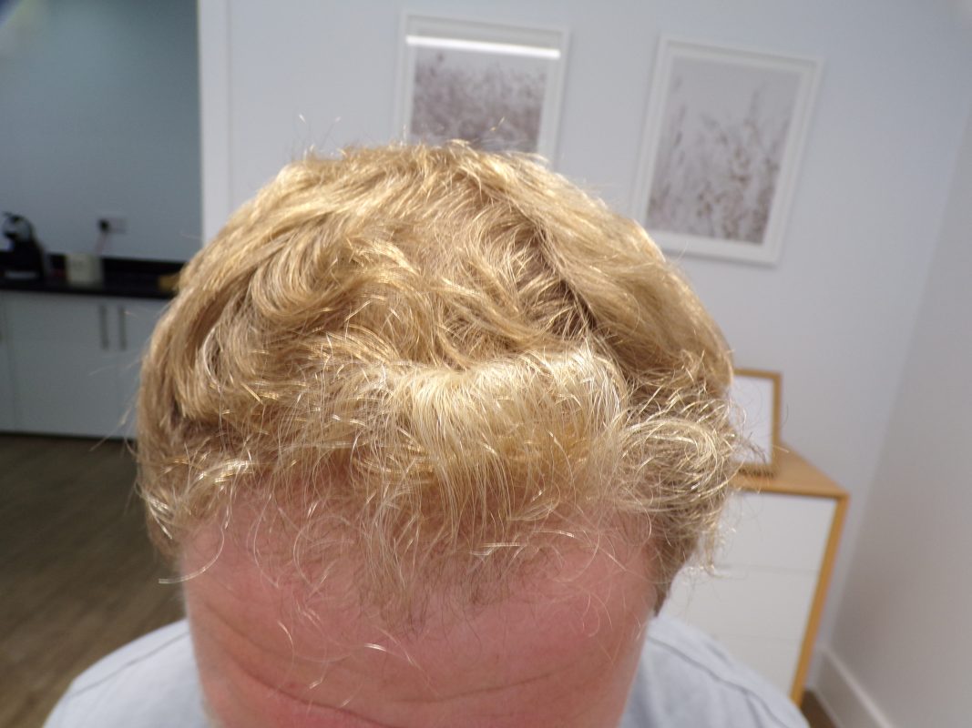 Frontal region after 4 months of treatment