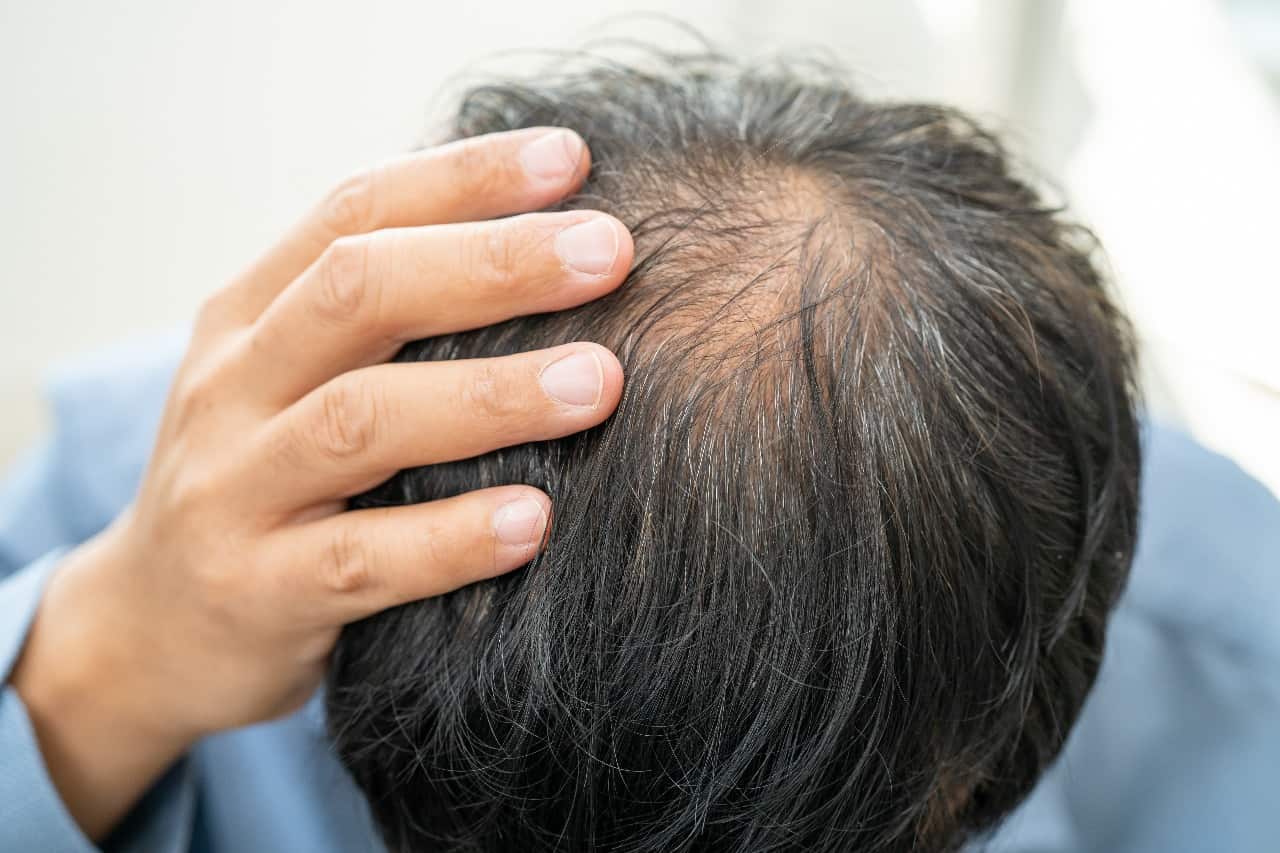 Safer hair loss treatment with finasteride spray