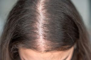 Expert hair thinning solutions in the UK