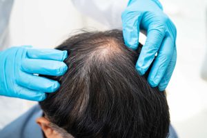 Identify early male pattern hair loss signs